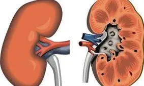 چگونه می توان فهمید کیست کلیه خطرناک است یا نه؟