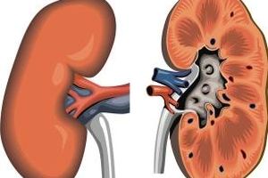 چگونه می توان فهمید کیست کلیه خطرناک است یا نه؟