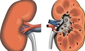 چگونه می توان فهمید کیست کلیه خطرناک است یا نه؟