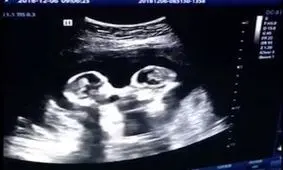 دعوای بامزه دوقلوها در رحم مادر ! + فیلم