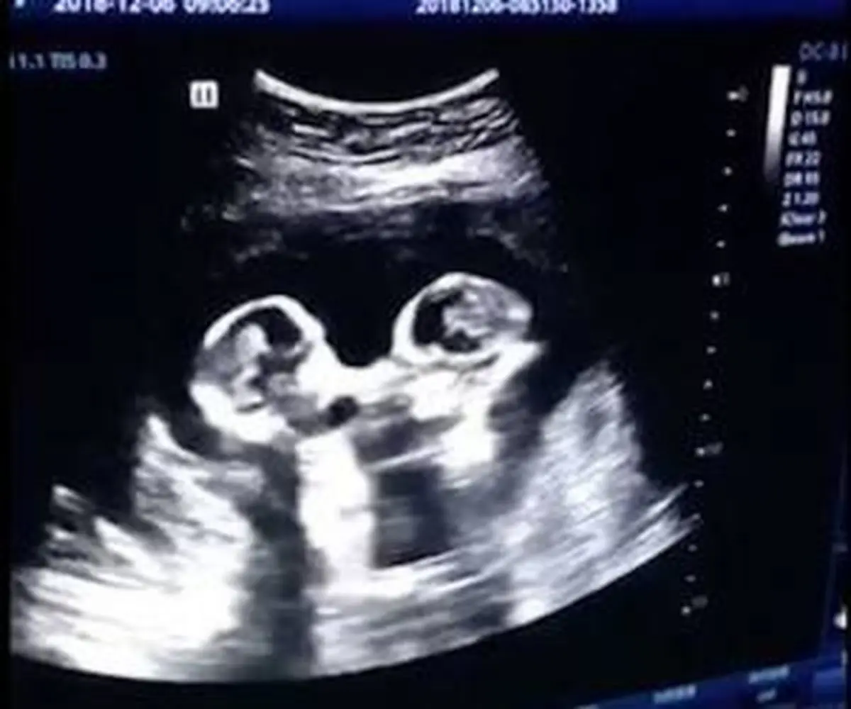 دعوای بامزه دوقلوها در رحم مادر ! + فیلم