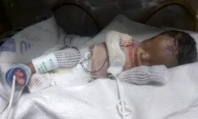 تولد نوزاد بدون پوست ! + تصاویر دلخراش 18+