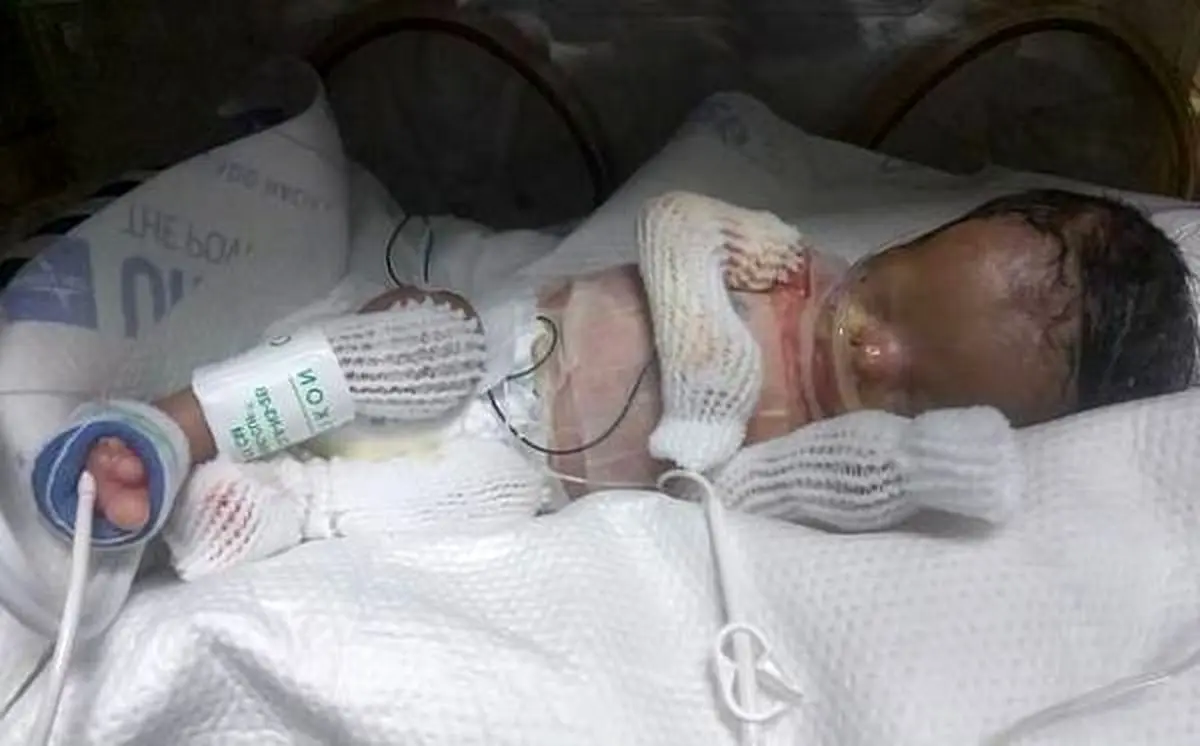 تولد نوزاد بدون پوست ! + تصاویر دلخراش 18+