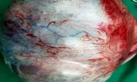 خارج کردن کیست ١٠ لیتری از بدن یک خانم در قم