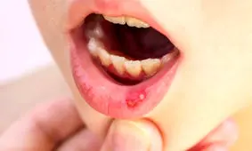 راهکارهایی کاربردی برای تسکین تبخال