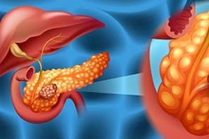 سرطان پانکراس چه علائمی دارد؟