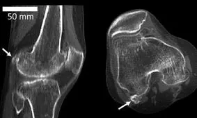 استخوان منسوخ شده دوباره در بدن انسان ظاهر شد!