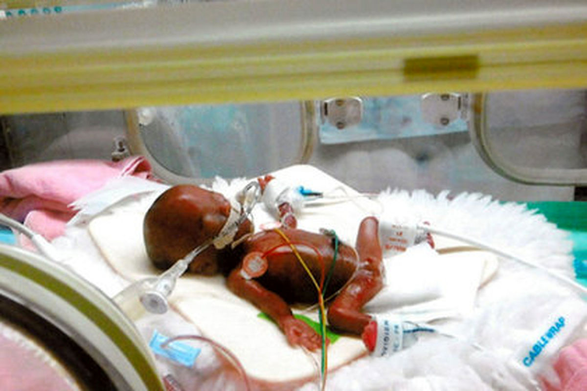 کوچکترین نوزاد جهان از بیمارستان مرخص شد +فیلم