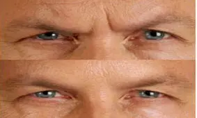 چطور خط اخم را از بین ببریم؟