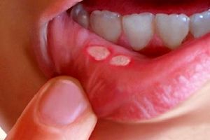آفت دهان خطرناک است؟
