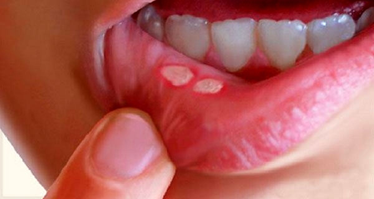 آفت دهان خطرناک است؟