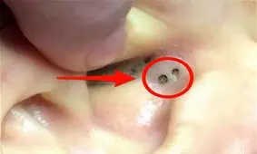 پیشگیری از ایجاد جوشهای سرسیاه