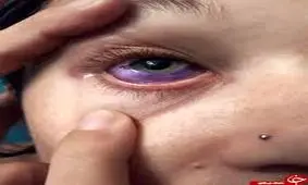 بیماری سرطان ارمغان خالکوبی های بدن