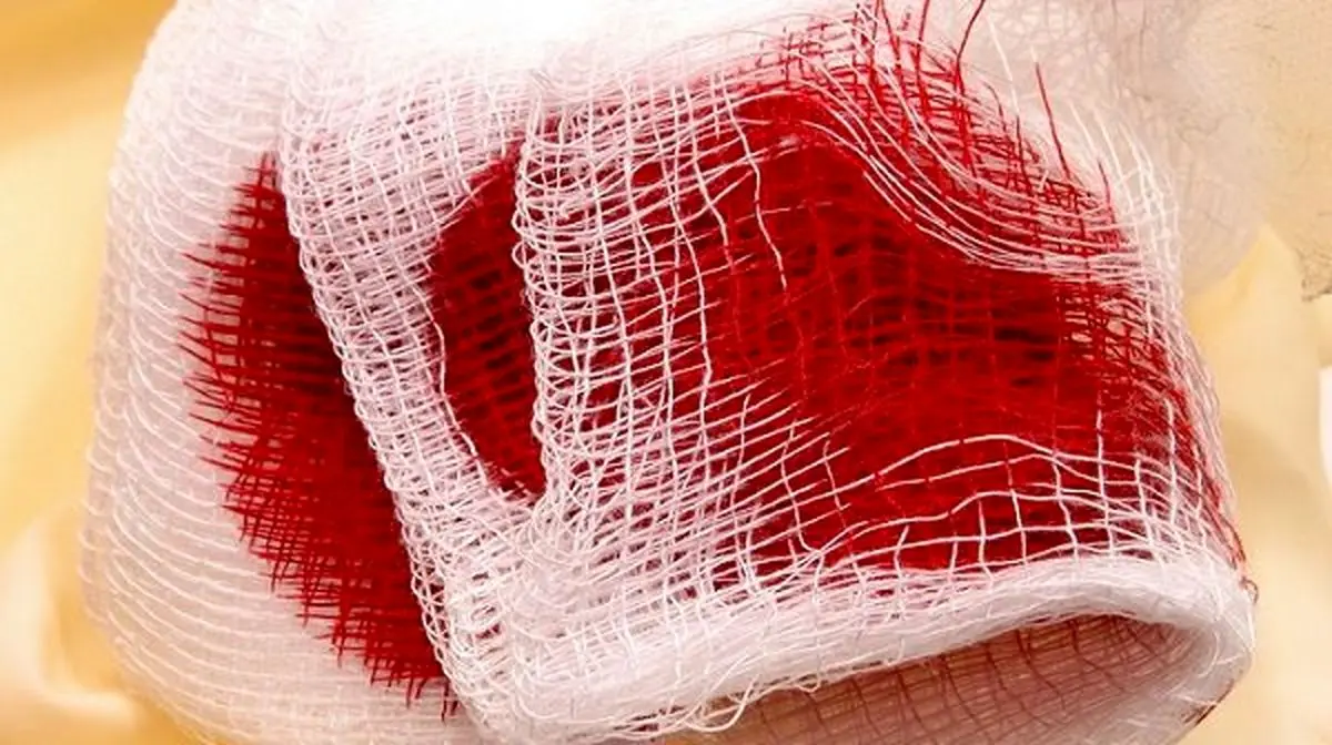 خونریزی نشانه کمبود کدام ویتامین در بدن است؟