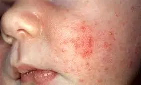 سرخک در کدام مناطق شایع است؟