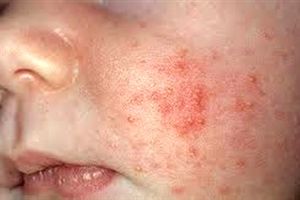 سرخک در کدام مناطق شایع است؟