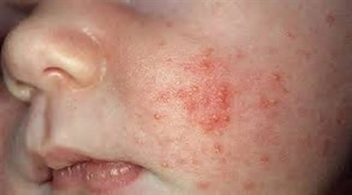 سرخک در کدام مناطق شایع است؟