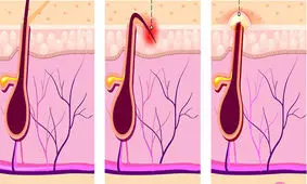 راه های درمان موهای زیر پوستی ناحیه تناسلی