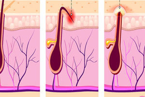 راه های درمان موهای زیر پوستی ناحیه تناسلی