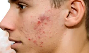 ۷ راهکار برای پیشگیری از جوش زدن صورت