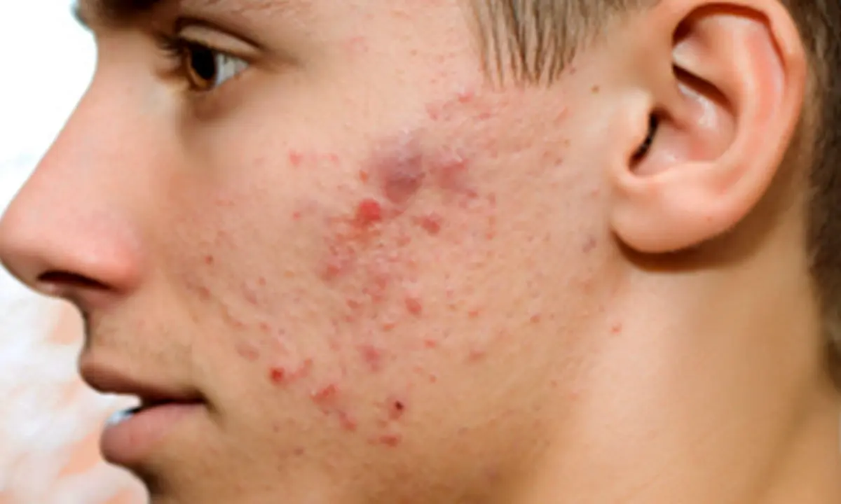 ۷ راهکار برای پیشگیری از جوش زدن صورت