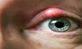 درمان گل مژه های دردناک با ترفندهای مادربزرگ ها