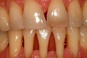 وراثت و افزایش سن خطری برای تحلیل لثه و سایش روی دندان