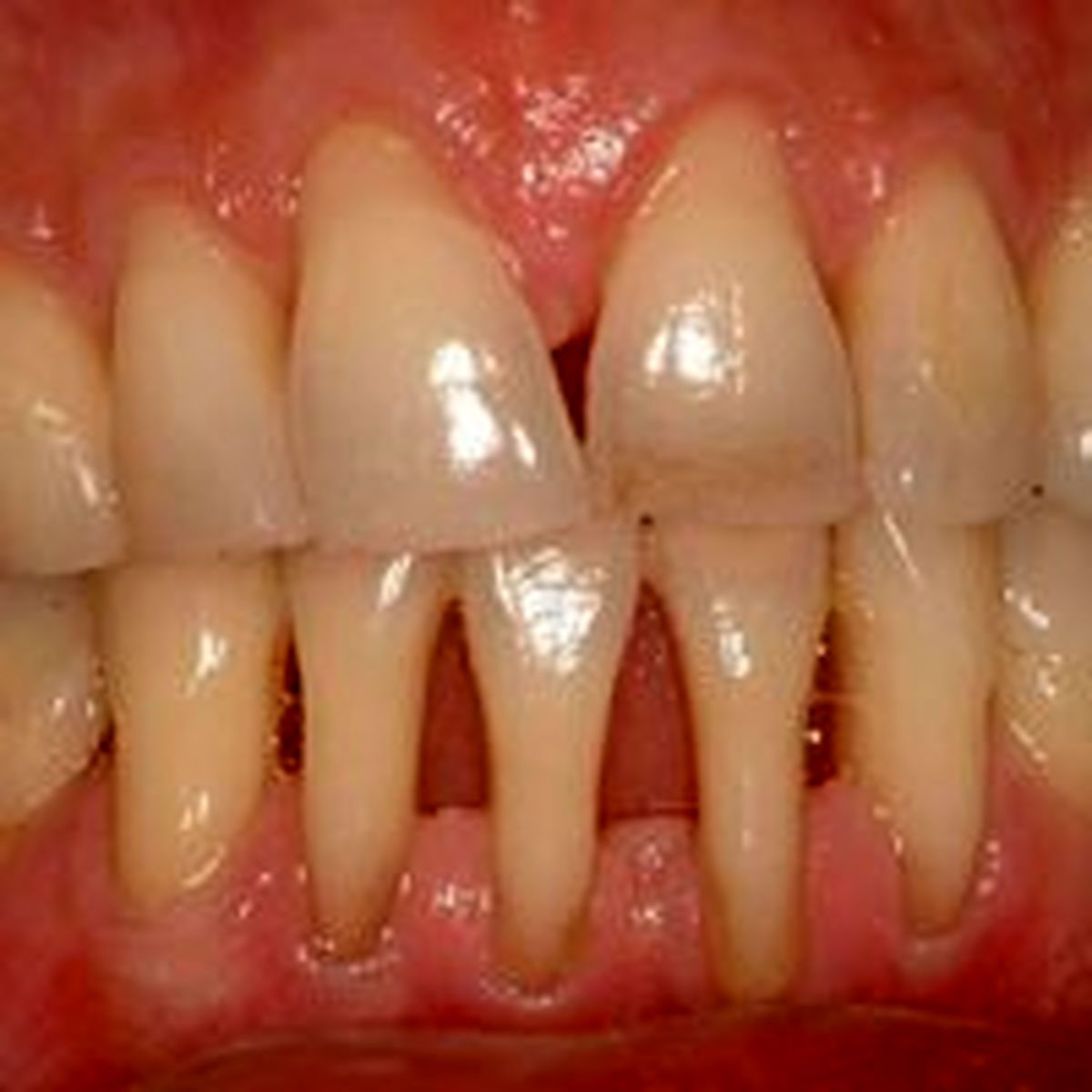 وراثت و افزایش سن خطری برای تحلیل لثه و سایش روی دندان