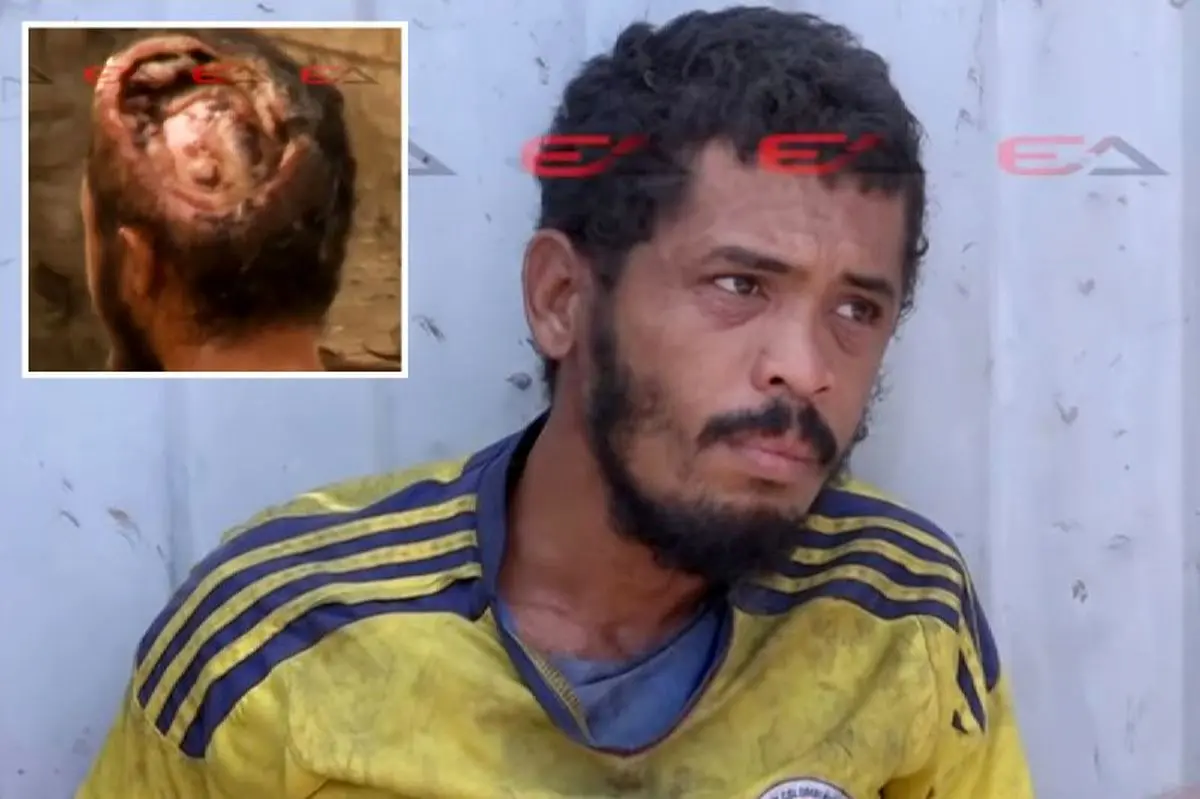 زندگی اسفناک بی‌خانمان کلمبیایی با حفره ای روی سر که مغزش پیدا بود!