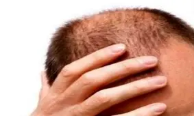 زیبایی موهای تان را با این ترفندها حفظ کنید/ ویتامین هایی که موها را شاداب می کنند