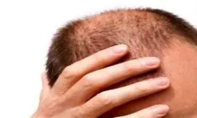 زیبایی موهای تان را با این ترفندها حفظ کنید/ ویتامین هایی که موها را شاداب می کنند