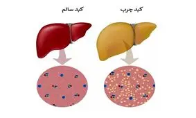 آیا می توان کبد چرب را درمان کرد؟