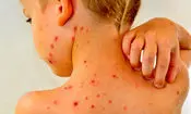آنچه والدین باید درباره آبله مرغان و زونا بدانند