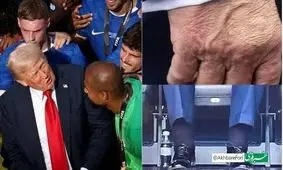 ارزیابی پزشک از وضعیت سلامتی دونالد ترامپ؛ تورم در پاها و کبودی روی دست