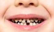 پوسیدگی دندان؛ شایع ترین بیماری در بشر