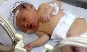 قطع نخاع نوزاد ۵ ماهه گلستانی بر اثر شکستن قلنج