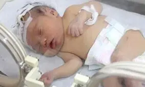قطع نخاع نوزاد ۵ ماهه گلستانی بر اثر شکستن قلنج