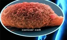 مردان ایرانی 5 برابربیشتر از زنان به سرطان مثانه مبتلا می شوند