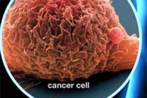 مردان ایرانی 5 برابربیشتر از زنان به سرطان مثانه مبتلا می شوند