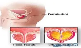 علت و علایم بزرگ شدن پروستات و روش های درمانی