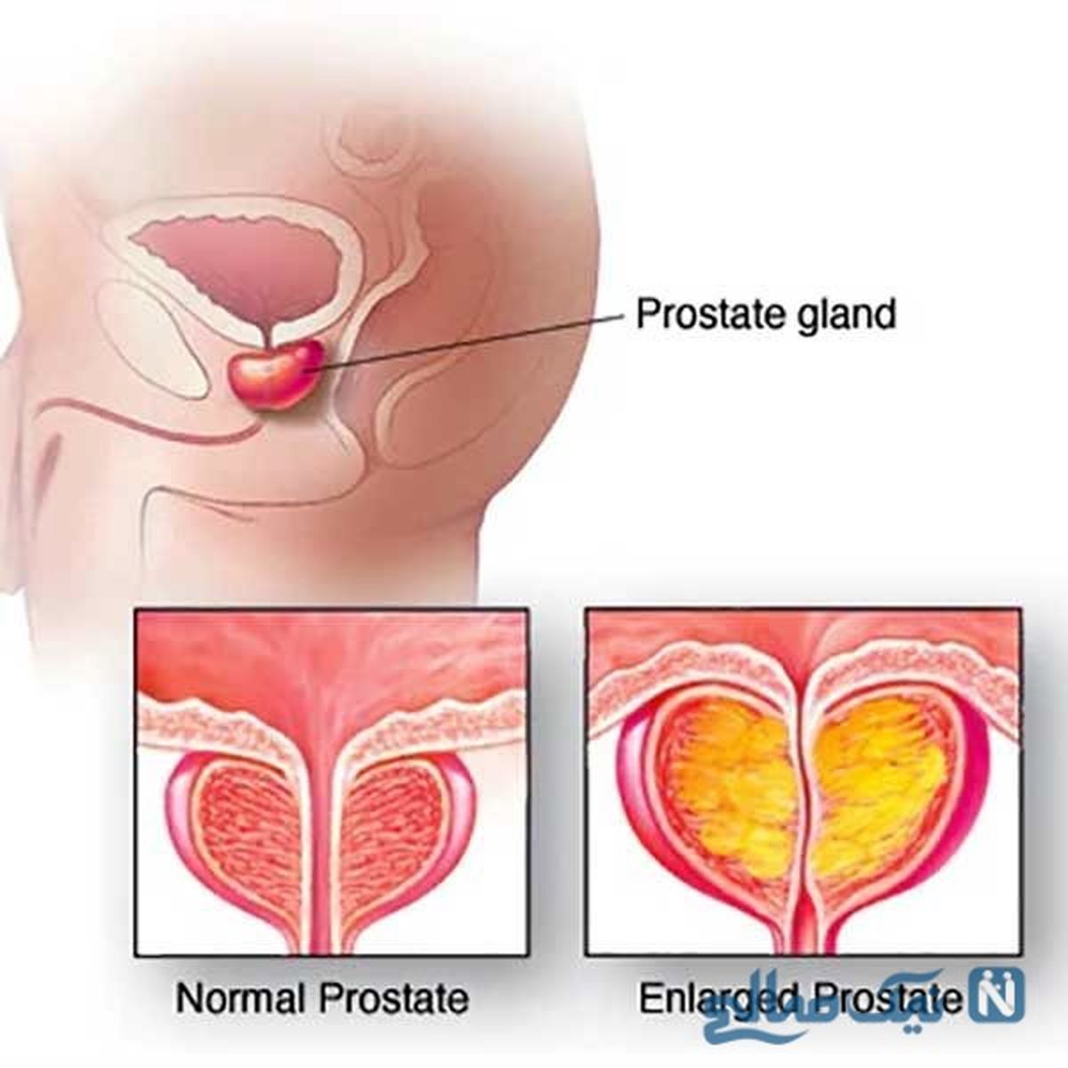 علت و علایم بزرگ شدن پروستات و روش های درمانی