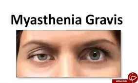 بیماری میاستنی گراویس و هر آنچه از آن نمی دانید