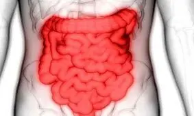 همه چیز درباره سرطان روده