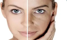 روش های طبیعی برای از بین بردن لکه‌های تیره پوست
