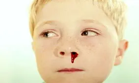 راهکار‌های سریع برای بند آوردن خون دماغ