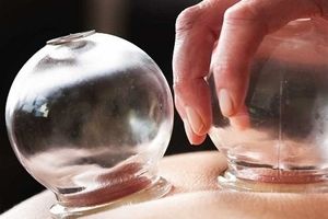 ۲۴ فایده حجامت که شاید ندانید