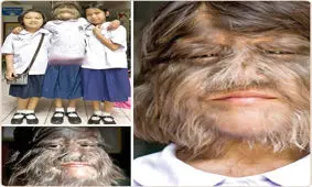 عجیب‌ترین و نادرترین بیماری‌های دنیا