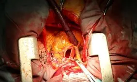 جزئیات انتقال قلب جوان ۲۴ ساله از یزد به تهران