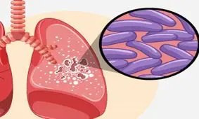 کاهش مقاومت آنتی‌بیوتیکی باکتری سل با ترکیبی جدید