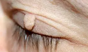 درمان منگوله های پوستی یا اسکین تگ با روش های خانگی